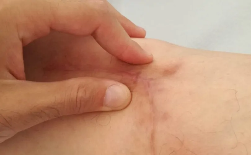Foto terapia Trattamento Cicatrici, praticata dal Dottor Canino Francesco, proprietario dello studio di fisioterapia 39