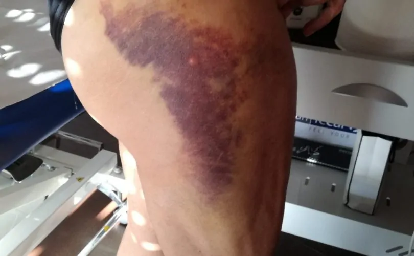 Foto terapia Trattamento Ematomi, praticata dal Dottor Canino Francesco, proprietario dello studio di fisioterapia 39
